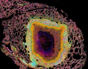 Granuloma